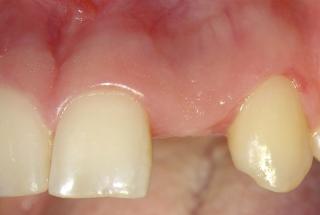 Agenesia de incisivo lateral izquierdo superior.