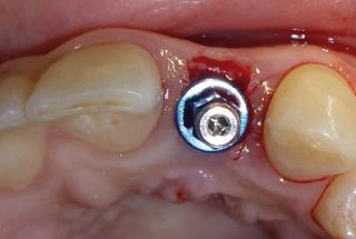 Colocación de implante IPHE413.