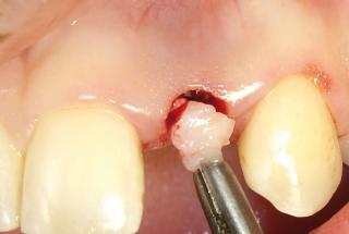 Injerto conectivo vestibular.