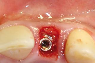 Vista oclusal antes y después del injerto conectivo vestibular.