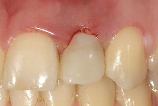 Diente provisional Inmediato.