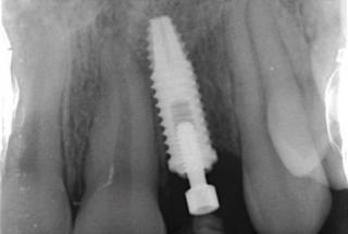 Rx Periapical de control.