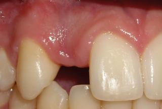 Agenesia de incisivo lateral derecho superior.