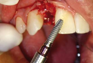 Incisión y colocación de implante IPHE313.