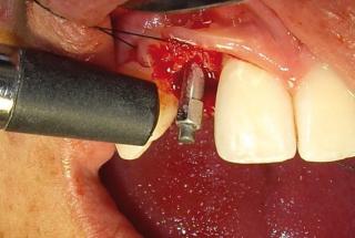 Medición de la estabilidad del implante mediante análisis de frecuencia de resonancia.