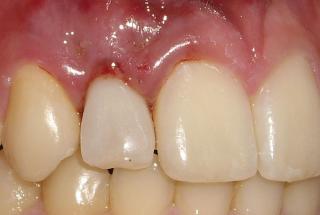 Diente provisional inmediato.