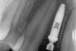 Rx Periapical de control.