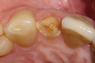 Fractura coronal y longitudinal de incisivo lateral derecho superior.