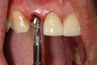 Infrafresado del lecho para el implante.