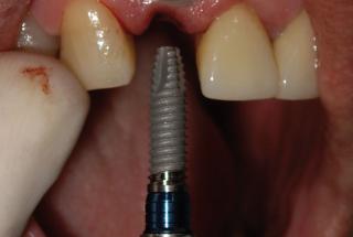 Colocación de implante IPHE415.