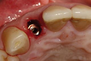 Vista oclusal del implante y la discrepancia residual.