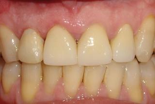 Diente provisional inmediato.