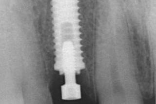 Rx Periapical de control.
