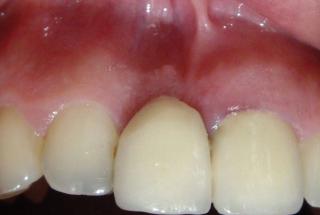 Ausencia de incisivo central superior derecho y defecto óseo residual.