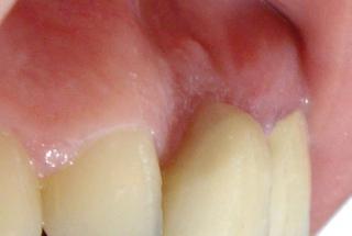 Ausencia de incisivo central superior derecho y defecto óseo residual.