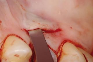 Incisión palatina de toma de injerto conectivo palatino.