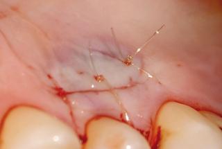 Sutura de incisión palatina.