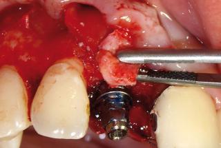 Fijación mediante suturas del injerto conectivo.