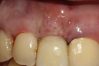 Diente provisional inmediato.