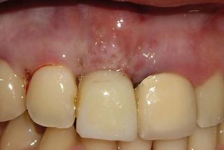 Diente provisional inmediato.