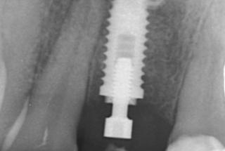 Rx Periapical de control.