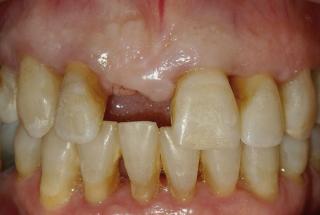 Agenesia de incisivo central superior derecho.