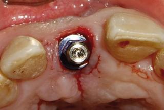 Colocación de implante IPHE415.