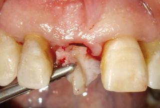 Injerto conectivo vestibular.