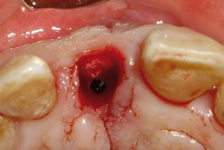 Vista oclusal de injerto conectivo vestibular.