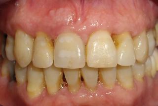 Provisional inmediato.