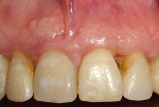 Provisional inmediato.