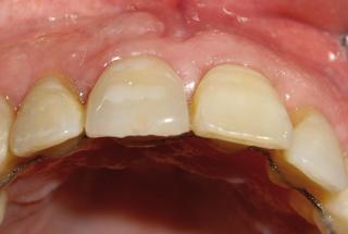Vista oclusal del provisional y el injerto de tejido conectivo vestibular.