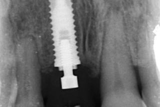 Rx Periapical de control.