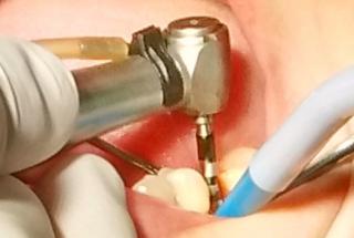 Fresado inicial del lecho con fresa Ø2 mm.