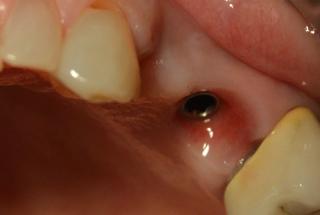 Ausencia de premolar lateral izquierdo superior.