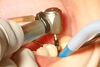 Fresado con fresa cónica Ø4,3 mm.