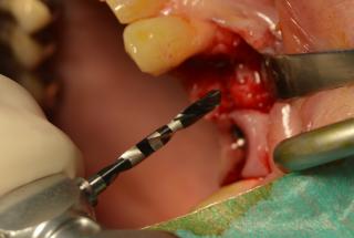 Fresado inicial con fresa piloto.