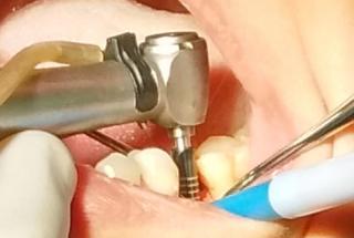 Fresado con fresa piloto para ampliar la parte superior del alveólo.