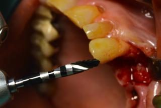 Fresado biológico con fresa cónica Ø3,5 mm.