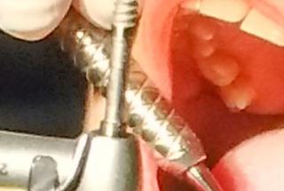 Inserción de implante.