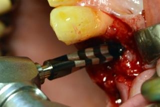 Infrafresado del lecho con fresa cónica Ø4,3 mm y longitud 11,5 mm.