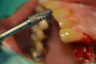 Colocación de implante IECM413.