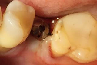 Vista oclusal del implante con pilar de cicatrización.