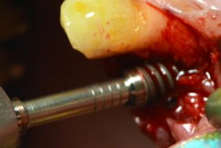 Inserción de implante.