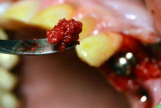 Aumento de volumen mediante injerto óseo propio.