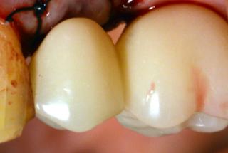 Sutura y colocación de puente provisional.