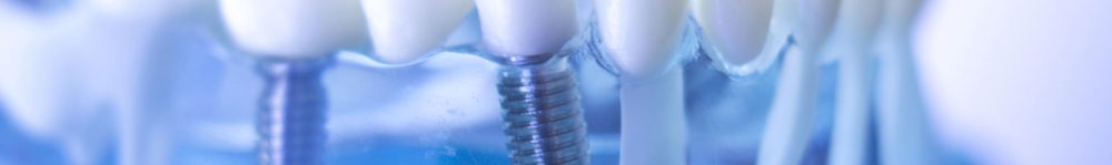 implantologia-clinca-dental-soler